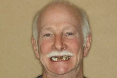 Patient face before smile restoration