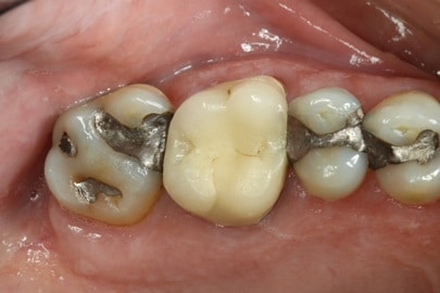 before reconstructive dentistry on back teeth