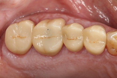 after reconstructive dentistry on back teeth