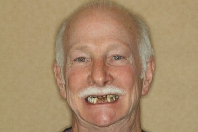full face view of male dental patient before Dr. Brisman was able to fix his smile