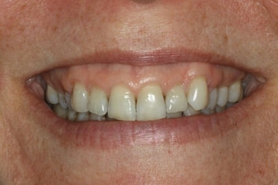 close up of teeth before a full-mouth reconstruction