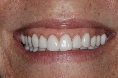 close up view of woman after a full-mouth reconstruction